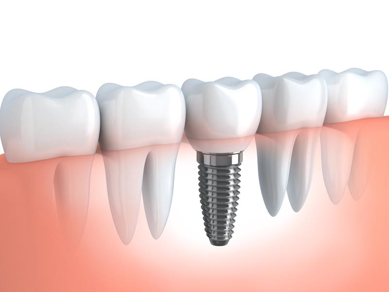 Dental Implants Eagan, MN