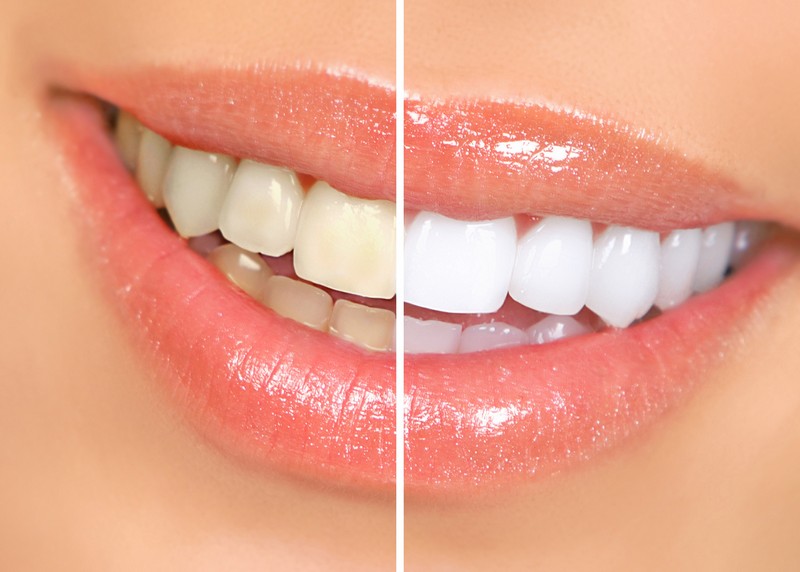 teeth whitening services Eagan, MN
